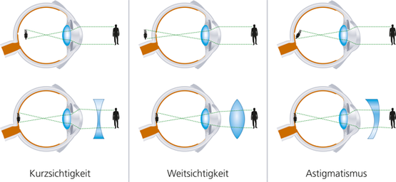 Kurzsichtigkeit