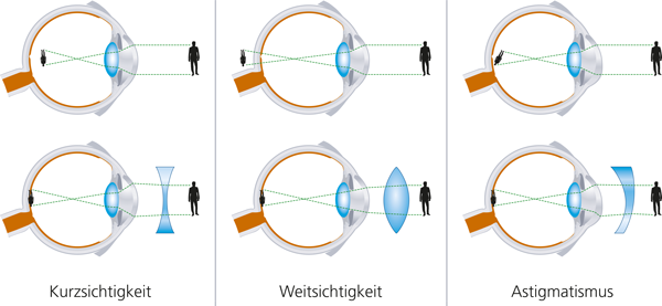 Kurzsichtigkeit